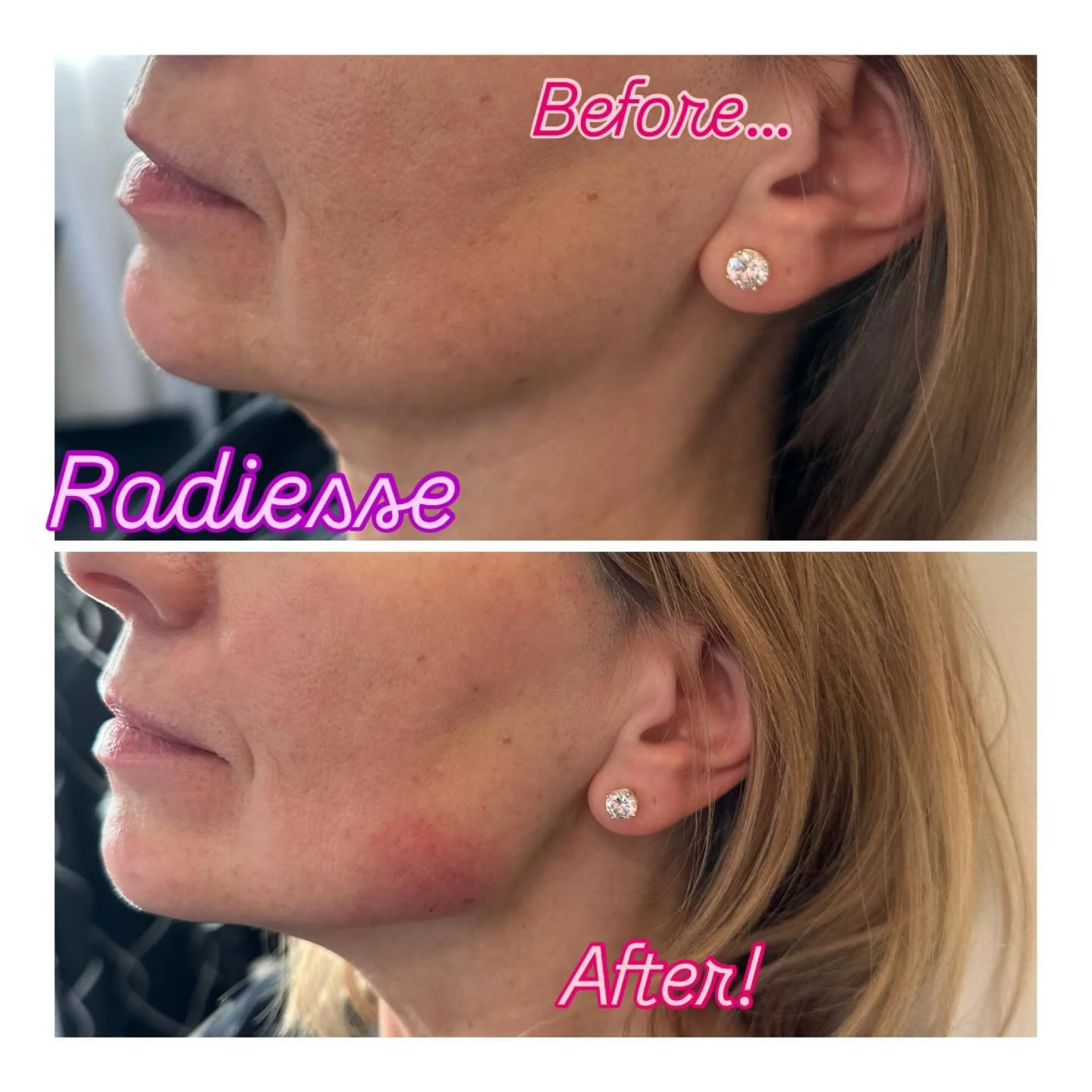 💉 RADIESSE&reg;: More Than Filler &mdash; A Biostimulator

Build your own collagen. Restore structure. Age gracefully.
What is Radiesse&reg;?

Radiesse&reg; is a biostimulatory injectable made of calcium hydroxylapatite (CaHA)&mdash;a substance natu