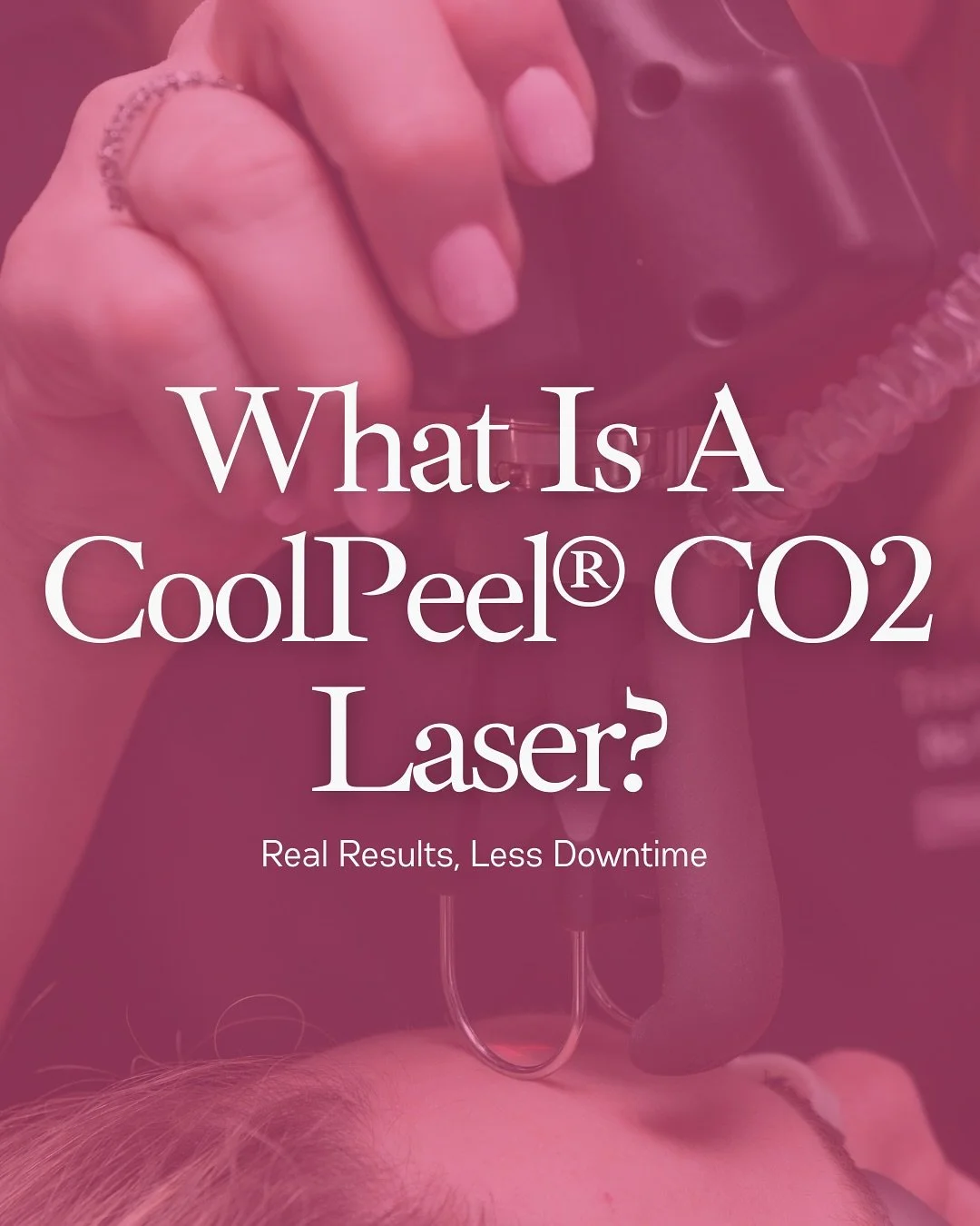 ✨ Experience advanced skin resurfacing with CoolPeel&reg; CO2 Laser, powered by the Tetra Pro system. This treatment improves fine lines, sun damage, uneven texture, and enlarged pores delivering noticeable results with minimal downtime.📩 Contact No