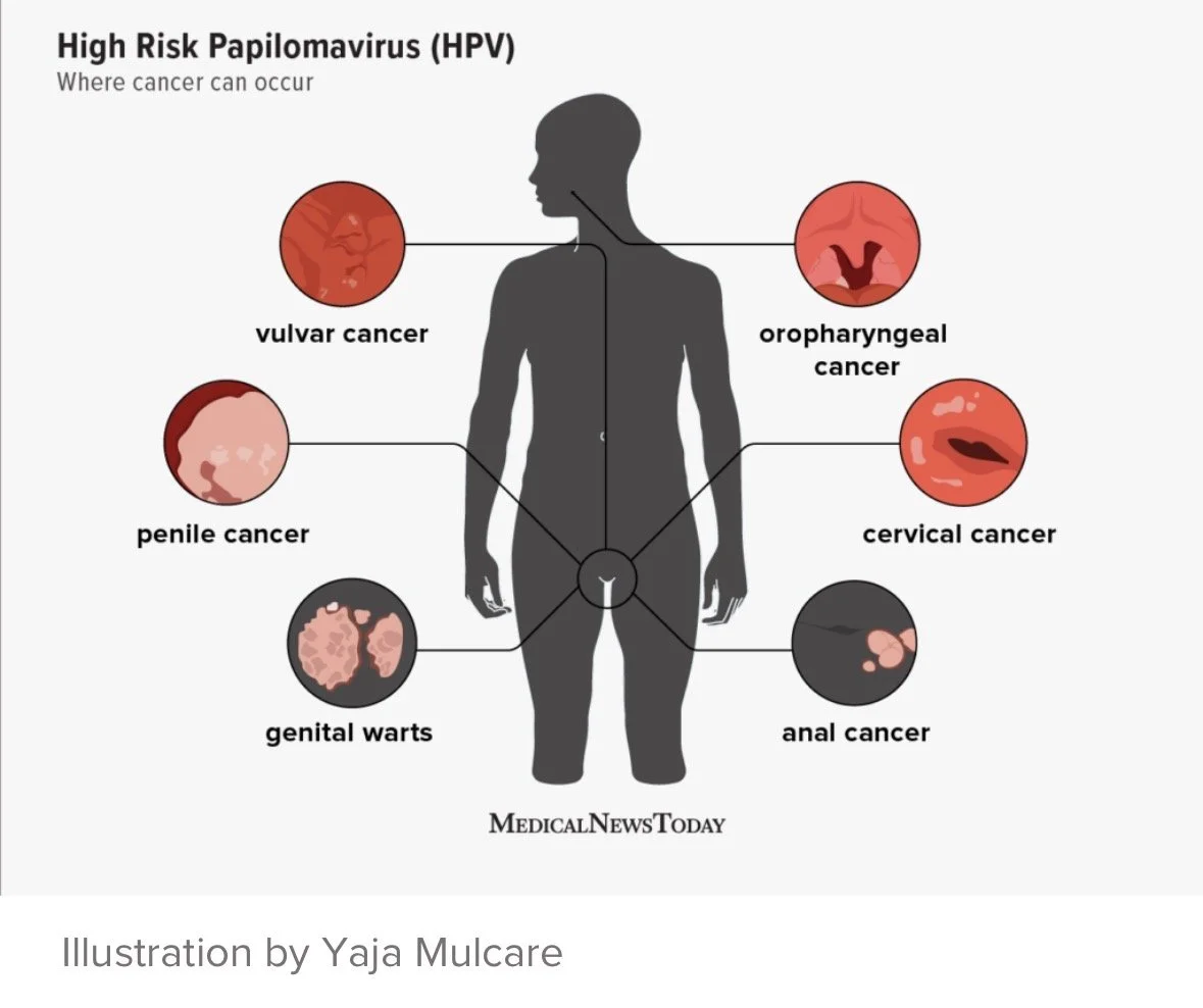 does circumcision decrease the risk of cancer, Circumcision decreases the risk of HPV, circumcision doctor, circumcision GP, infant circumcision, boys circumcision