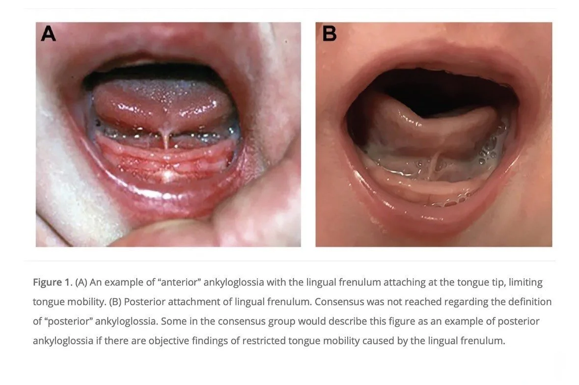 Tongue ties vary, not just a little tongue tie, anterior tongue ties, posterior tongue tie, all tongue ties can cause an issue, function is as important as appearance, tongue tie doctor, oral tie doctor, if symptoms persist, breastfeeding trouble