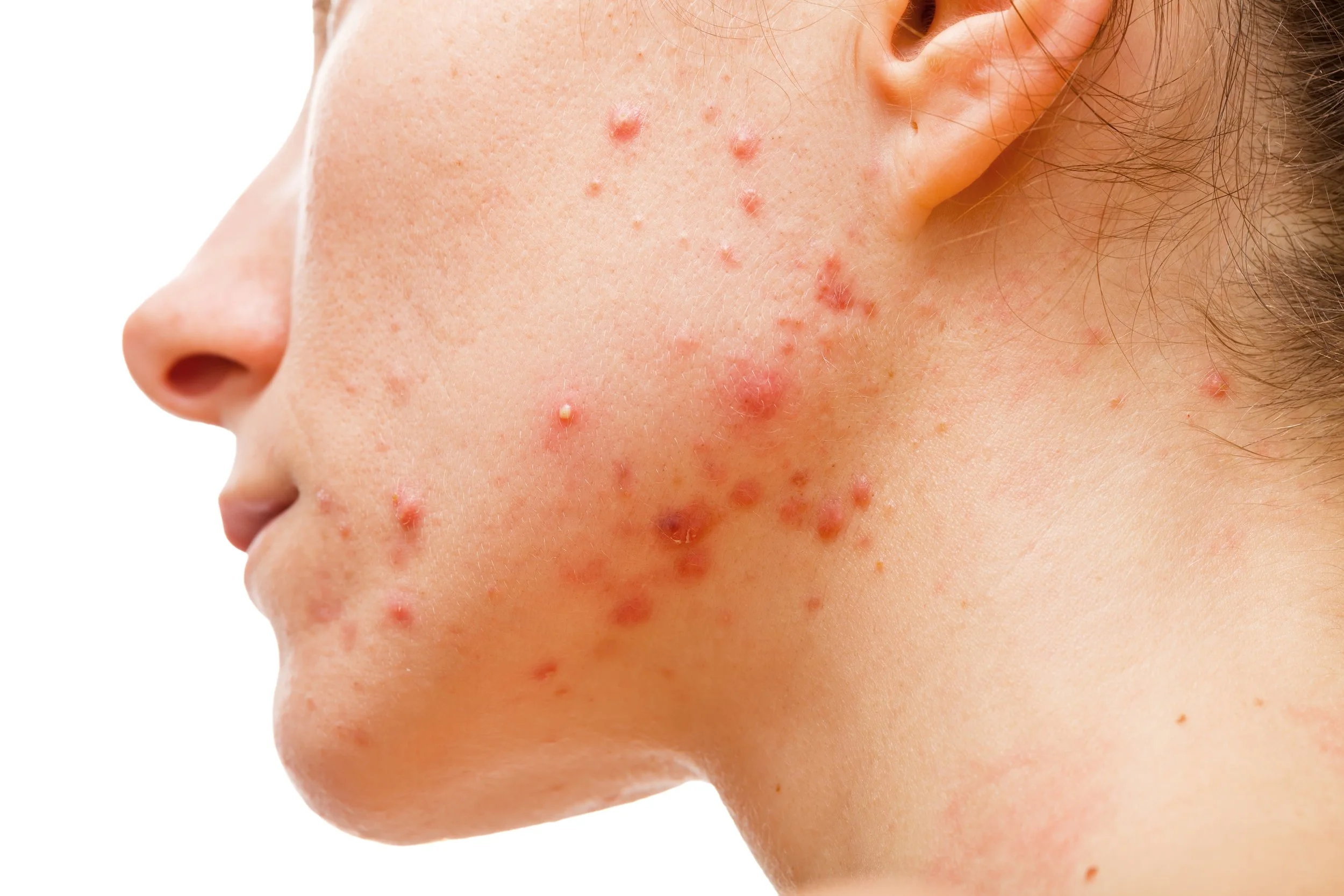Hormonal Acne Leonie Thorne Skin Studio Southampton