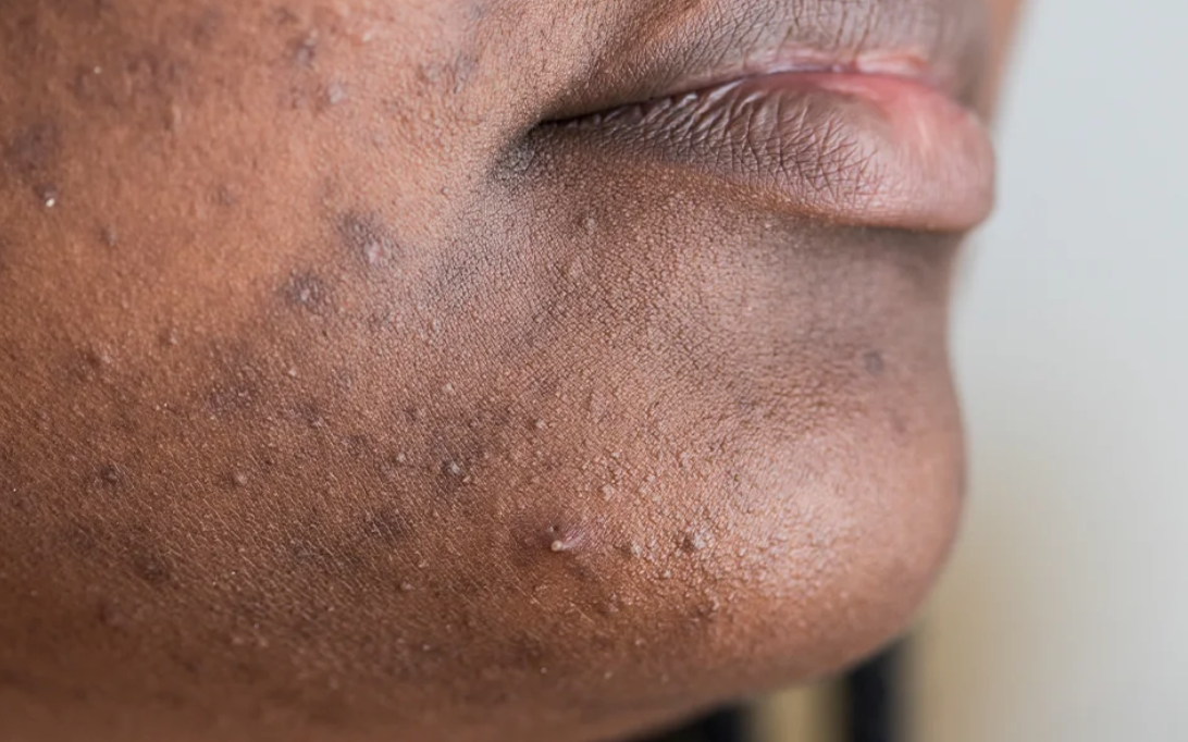 Pigmentation Acne Mark Leonie Thorne Skin Studio Southampton