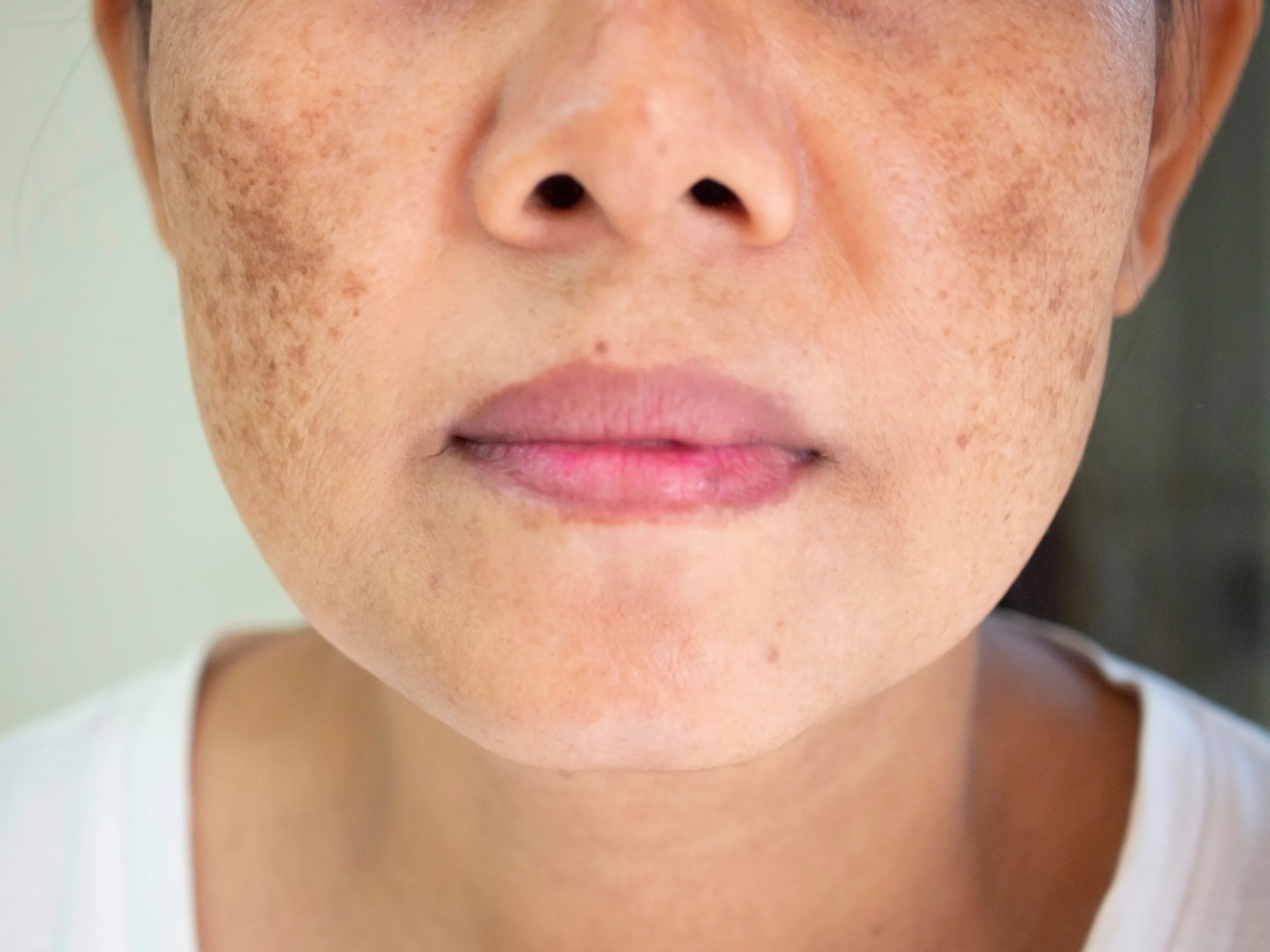 Melasma Pigmentation Leonie Thorne Skin Studio-southampton