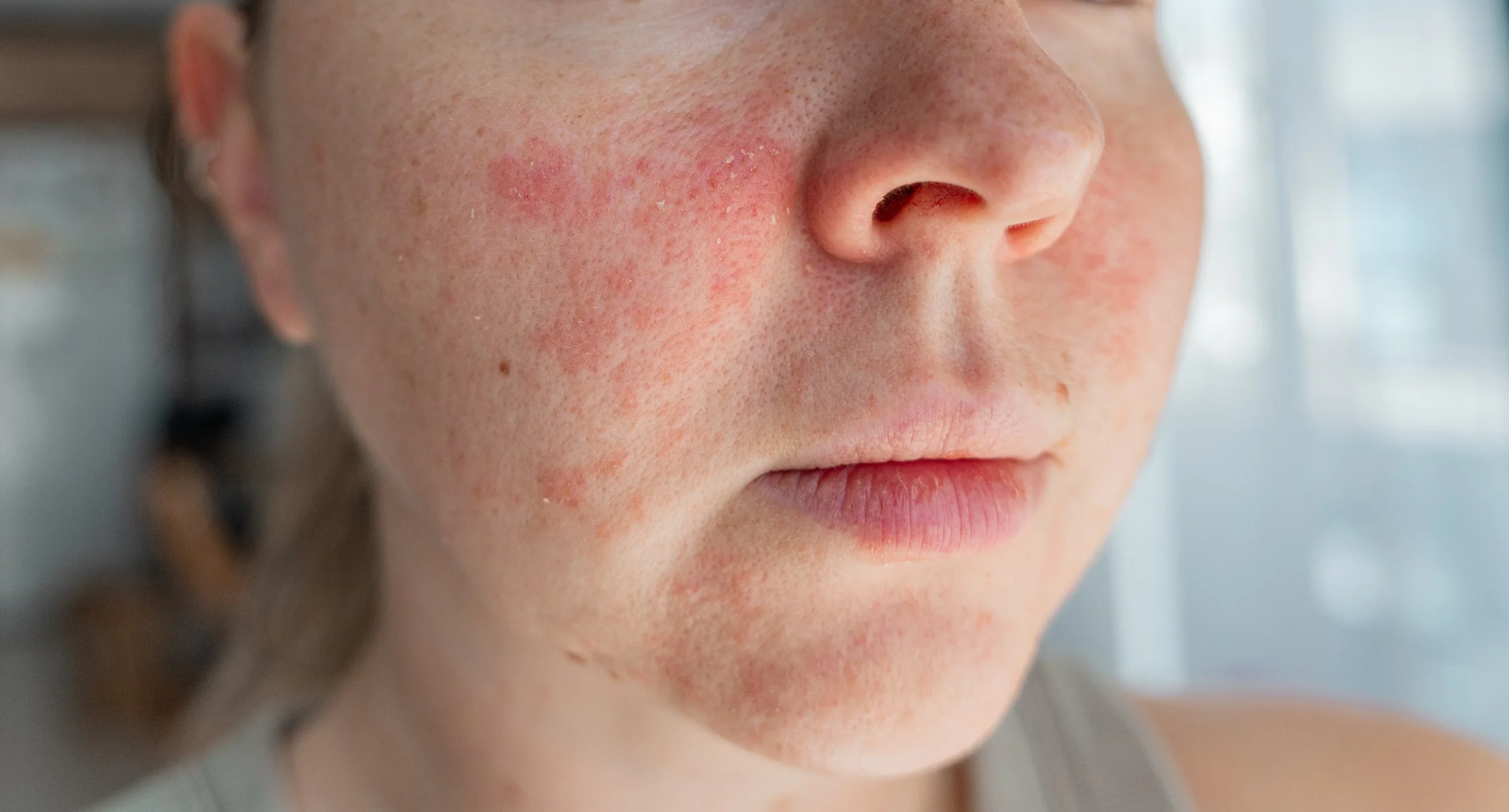 Sensitive Skin Leonie Thorne Skin Studio Southampton