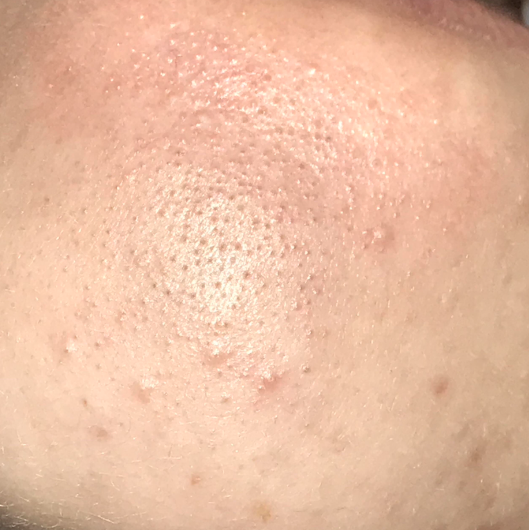 Incorrect Skincare Acne Leonie Thorne Skin Studio Southampton