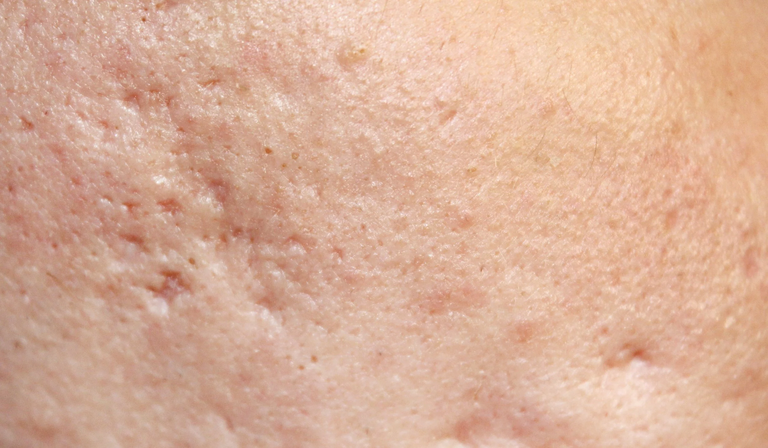Acne Scarring Leonie Thorne Skin Studio Southampton