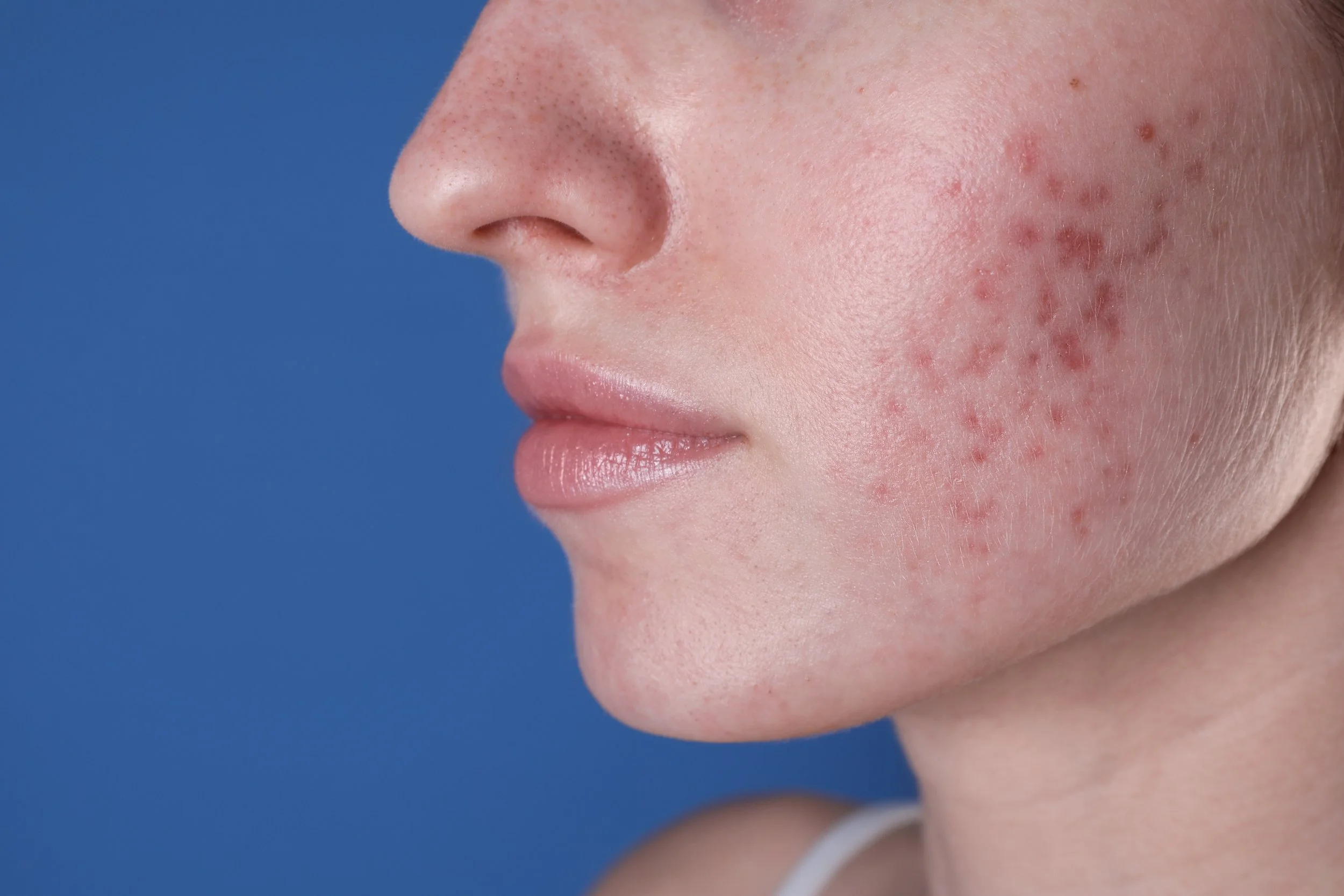 Red Marks Acne Leonie Thorne Skin Studio Southampton