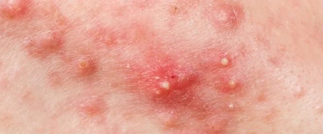 Inflammation Acne Leonie Thorne Skin Studio Southampton