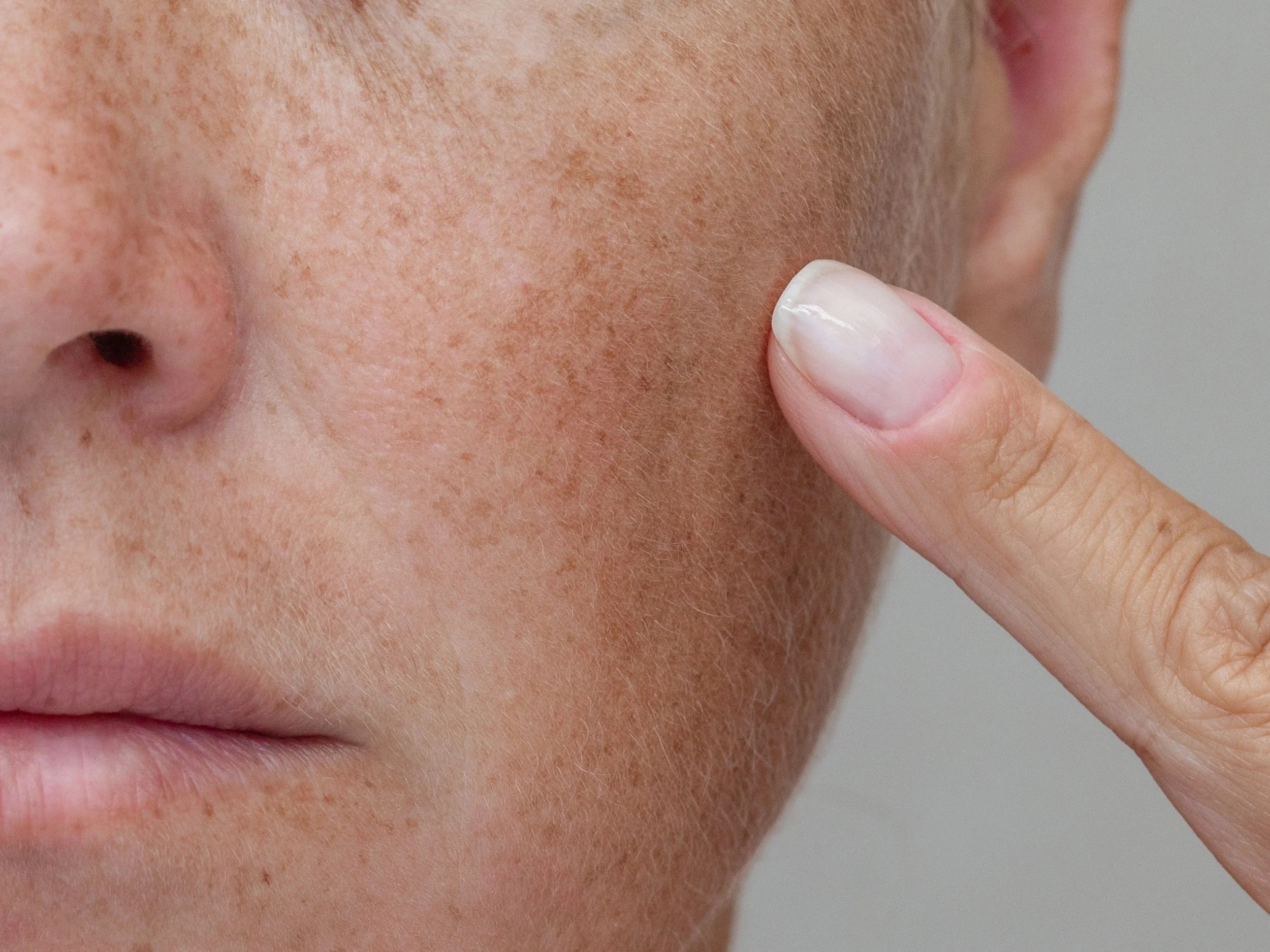Sun Damage Leonie Thorne Skin Studio Southampton