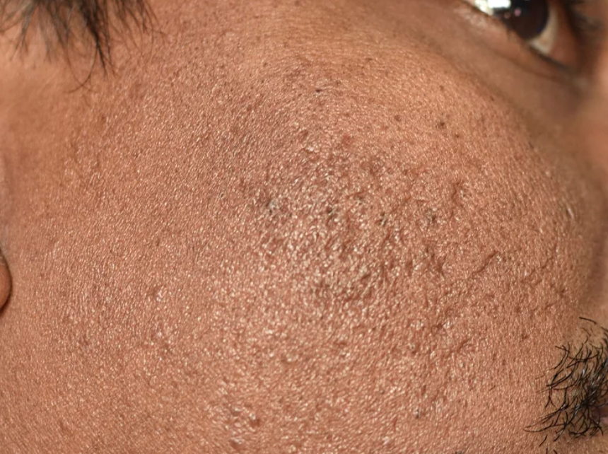 Boxcar Acne Scar Leonie Thorne Skin Studio Southampton
