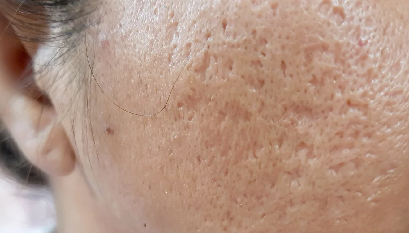 Icepick Scarring Leonie Thorne Skin Studio Southampton