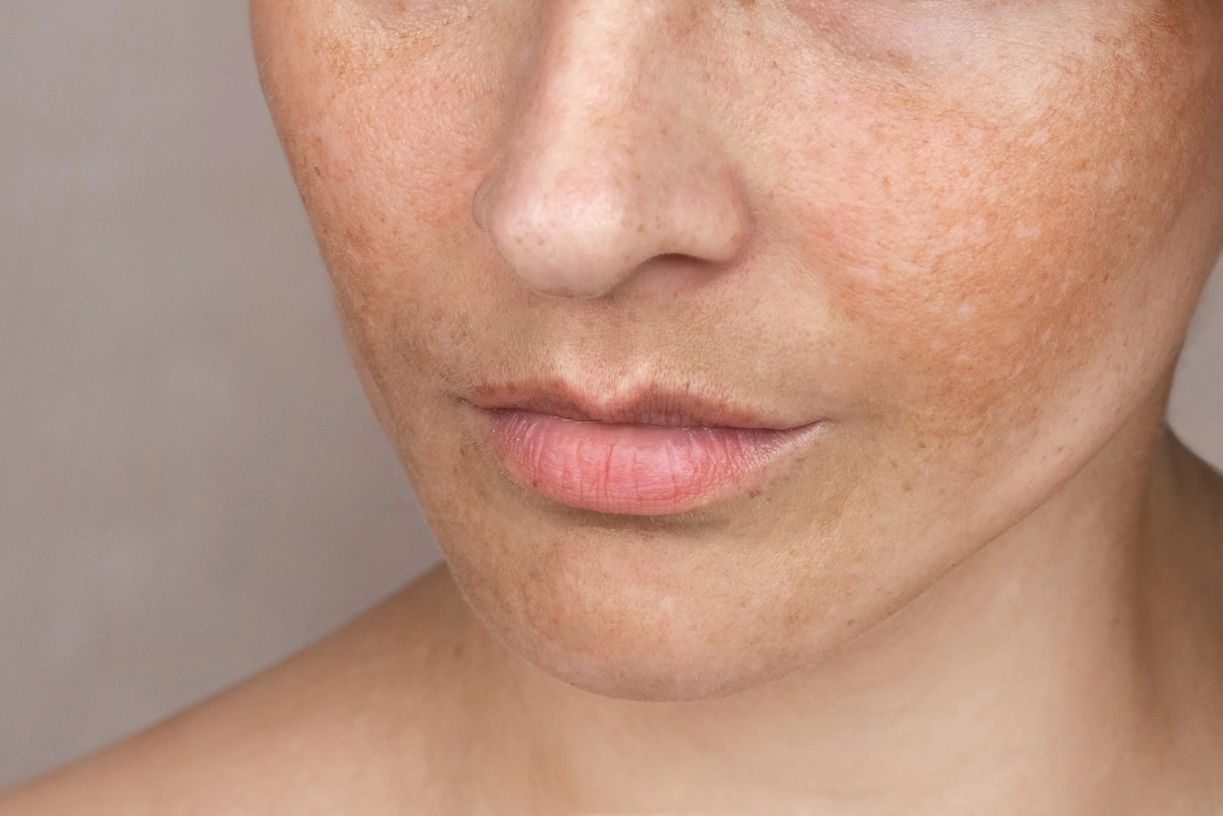 Pigmentation Hormonal Leonie Thorne Skin Studio Southampton