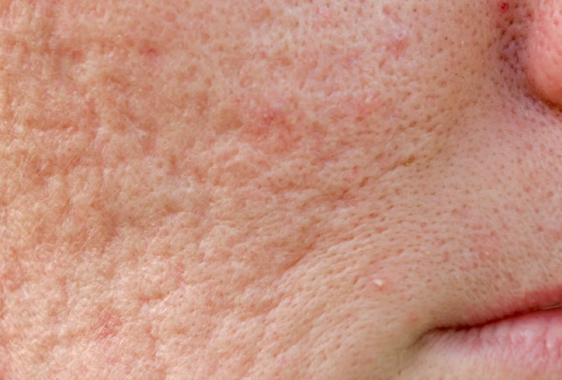 Rolling Acne Scar Leonie Thorne Skin Studio Southampton