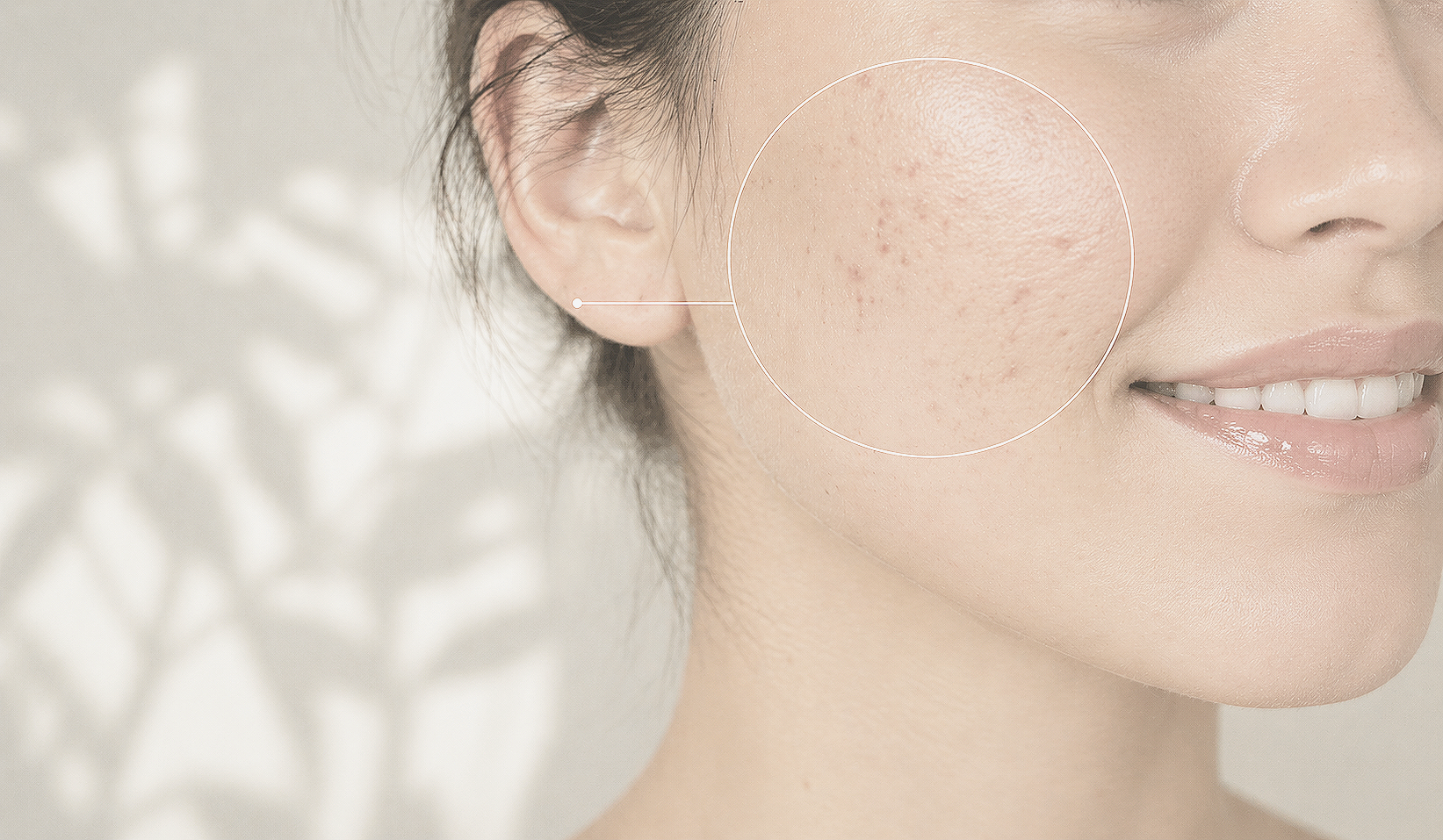 woman close up cheek acne acne scars