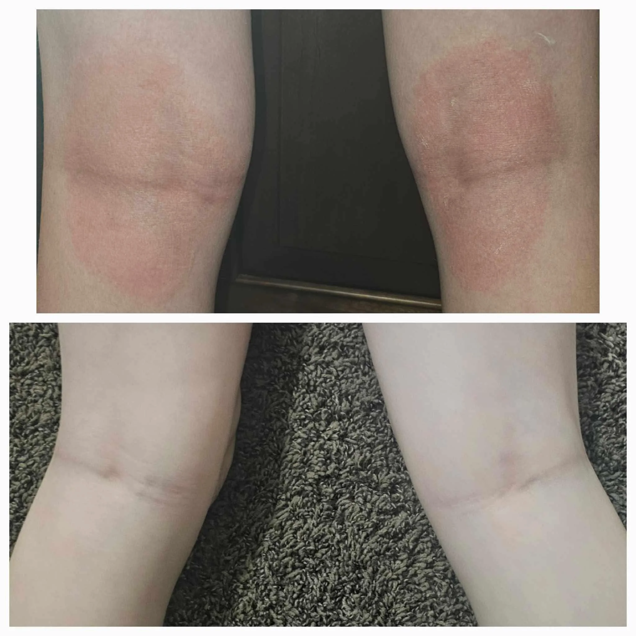 Comparison of knees: the top image shows knees with redness and irritation, while the bottom image shows knees with smooth, clear skin.
