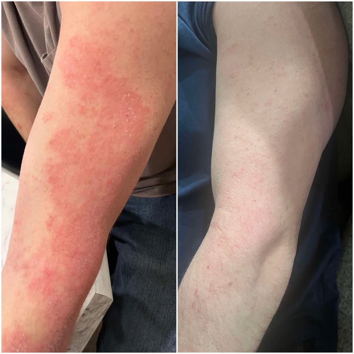 Comparison of a forearm with a skin rash on the left and the same forearm showing improved skin on the right