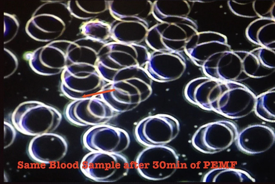 Microscopic view of blood sample, showing numerous red blood cells with some labeled after 30 minutes of PEMF treatment.