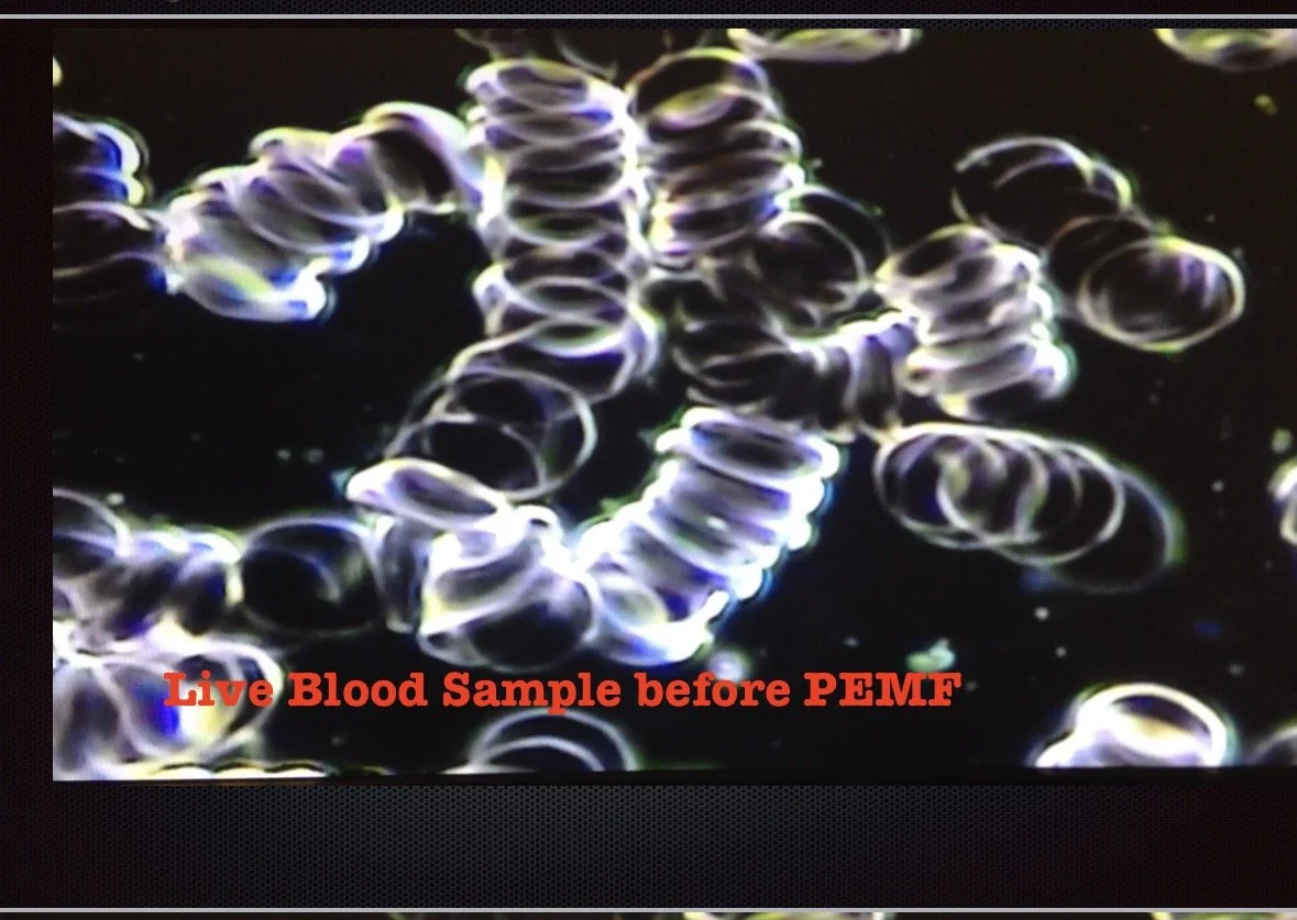 Close-up image of blood cells under a microscope with the text "Live Blood Sample before PEMF" in red.