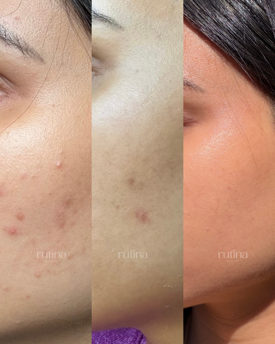 Acne treatment before and after