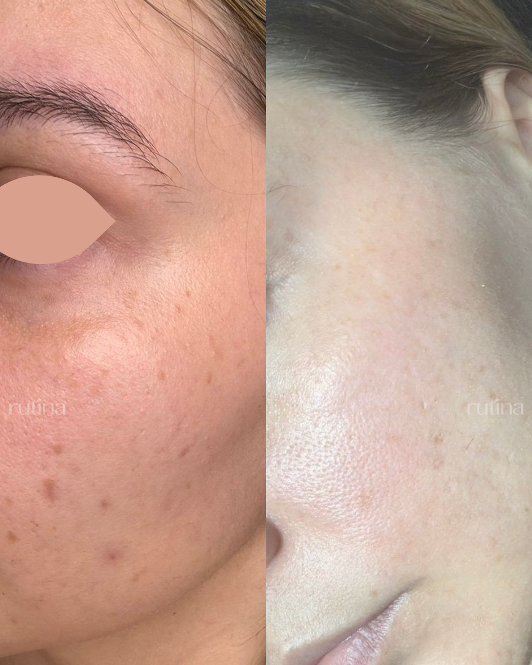 Texture and pigmentation virtual skincare consultation