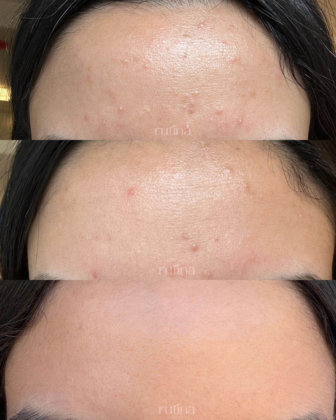 Acne treatment before and after