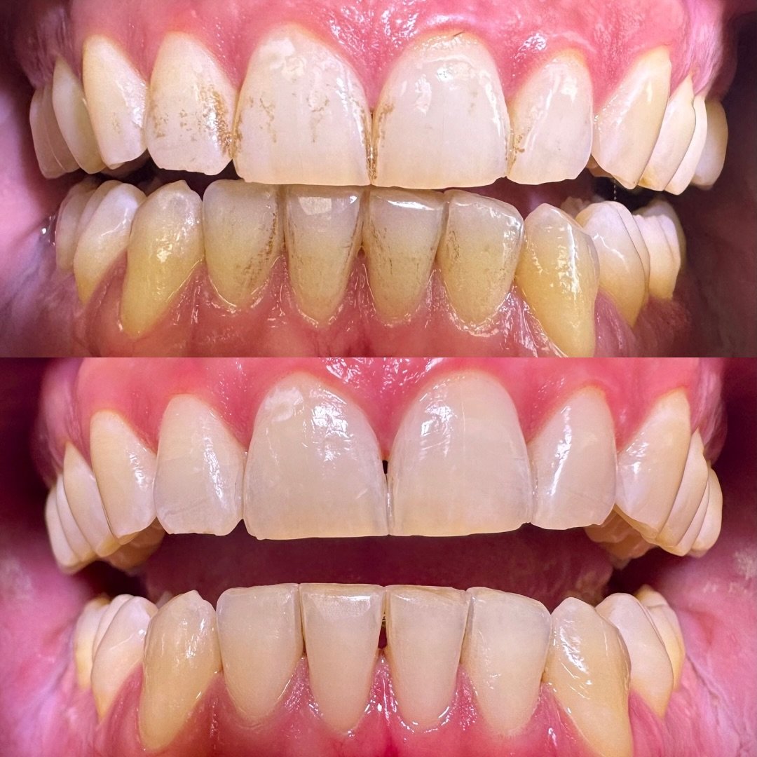 ✨ Voor & Na ✨Wat een verschil!
Op de eerste foto zie je duidelijk aanslag op het gebit, iets wat we vaak tegenkomen. Maar na een professionele gebitsreiniging met onze Airflow/zoutstraler, zien de tanden er al een stuk frisser en witter uit! 🦷