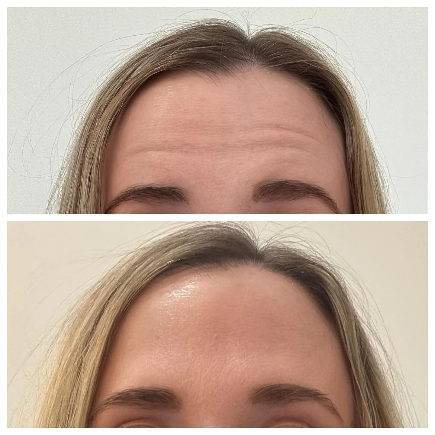 Here&rsquo;s my forehead before and after Jeuveau. (Yes I&rsquo;m making the same face). Not only does it soften, or basically resolve, any forehead lines, it&rsquo;s also helping to prevent wrinkles in the future!

I had also been experiencing tensi