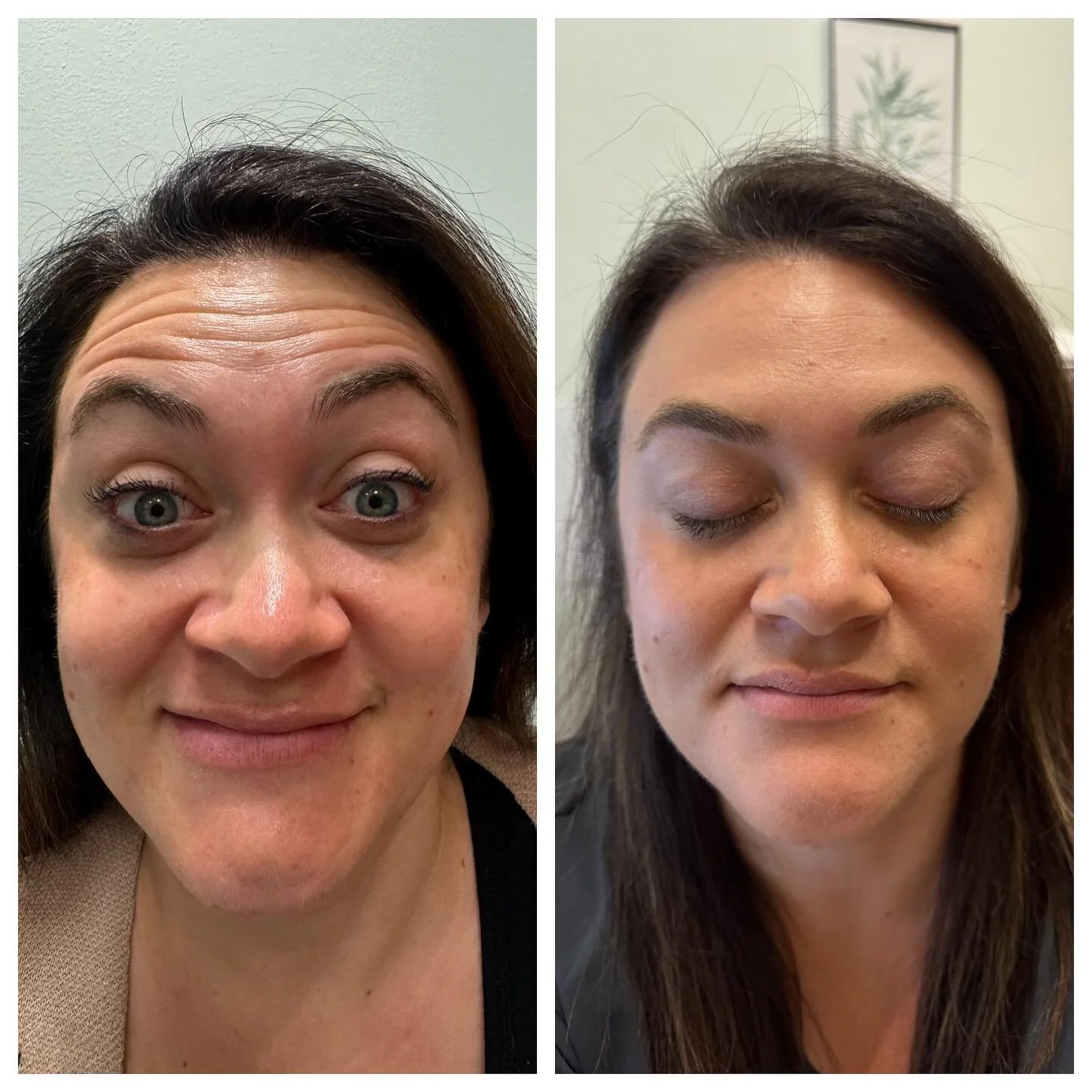Same beautiful face before and after treatment with Jeuveau #VAW #jeuveau 

*Posted with permission from the client*