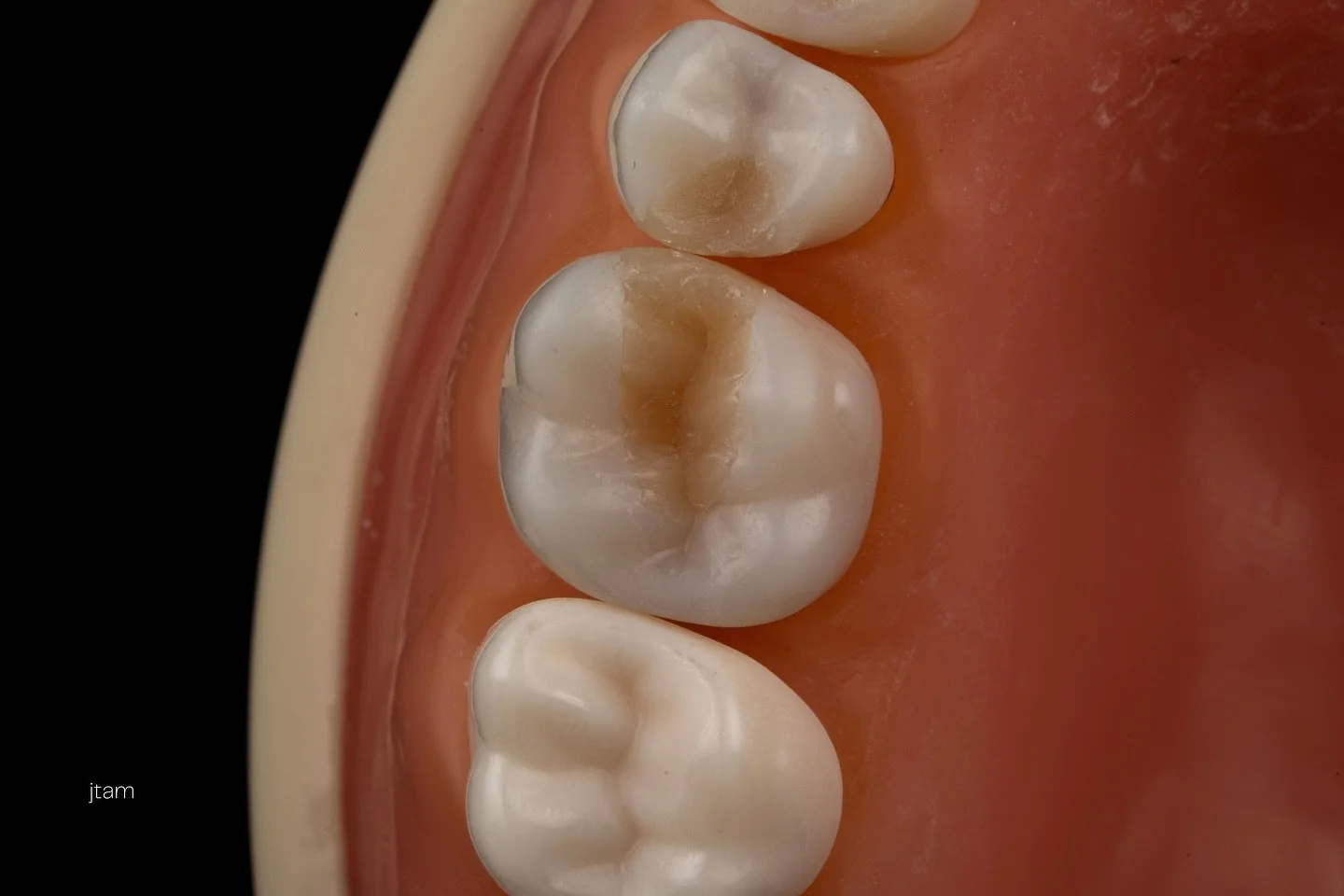 Some better photos of class II restorations from sim clinic recently. Still yet to be finished and polished.