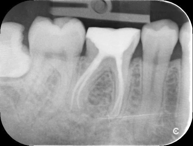 Root Canal Treatment