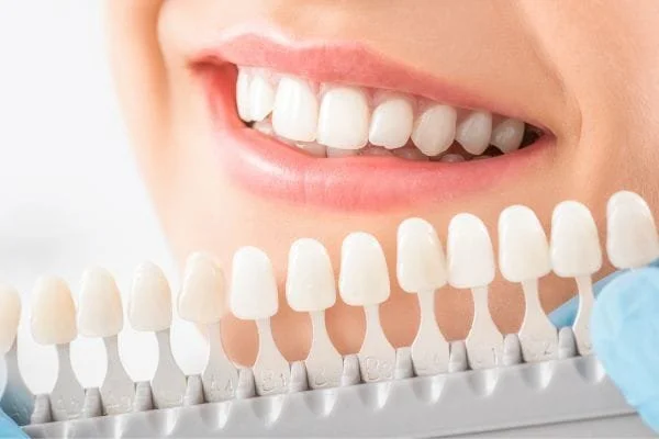 Teeth Whitening