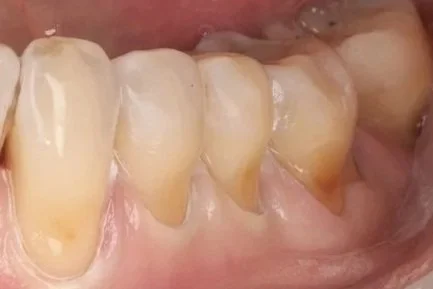 Buccal Restorations