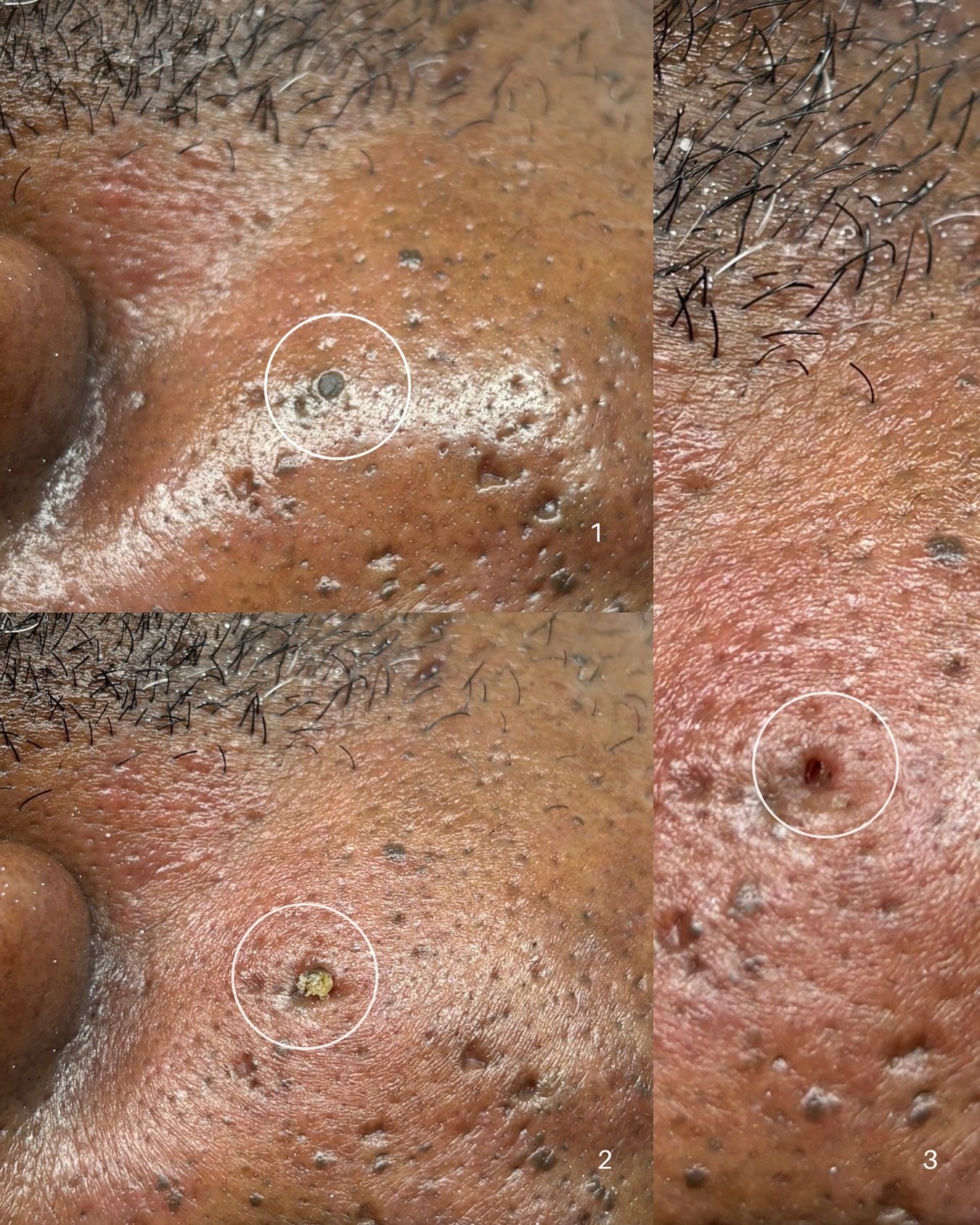 Pore impaction | Advanced Removal

I run into this situation quite often especially among clients w/ DPN (Dermatosis Papulosa Nigra). They can mistake a pore impaction/blackhead for a &ldquo;mole&rdquo; and it never gets treated. [1] In these situati