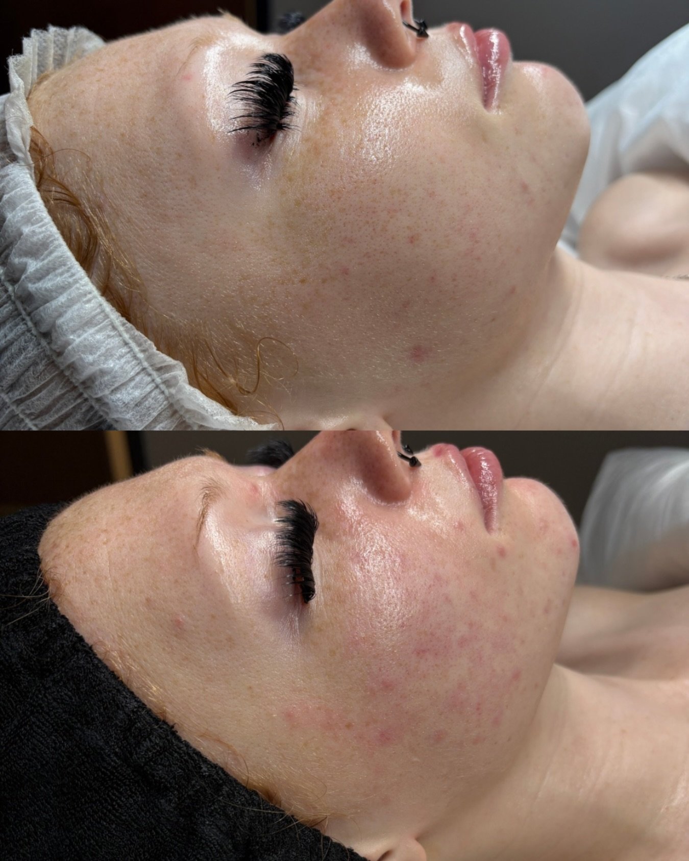 R&amp;R | Relaxation + Results

After 3 treatments, we see a significant reduction in this client&rsquo;s breakout activity and post-inflammatory erythema (PIE)

This client continued her normal home care routine, with modifications on usage. Every &