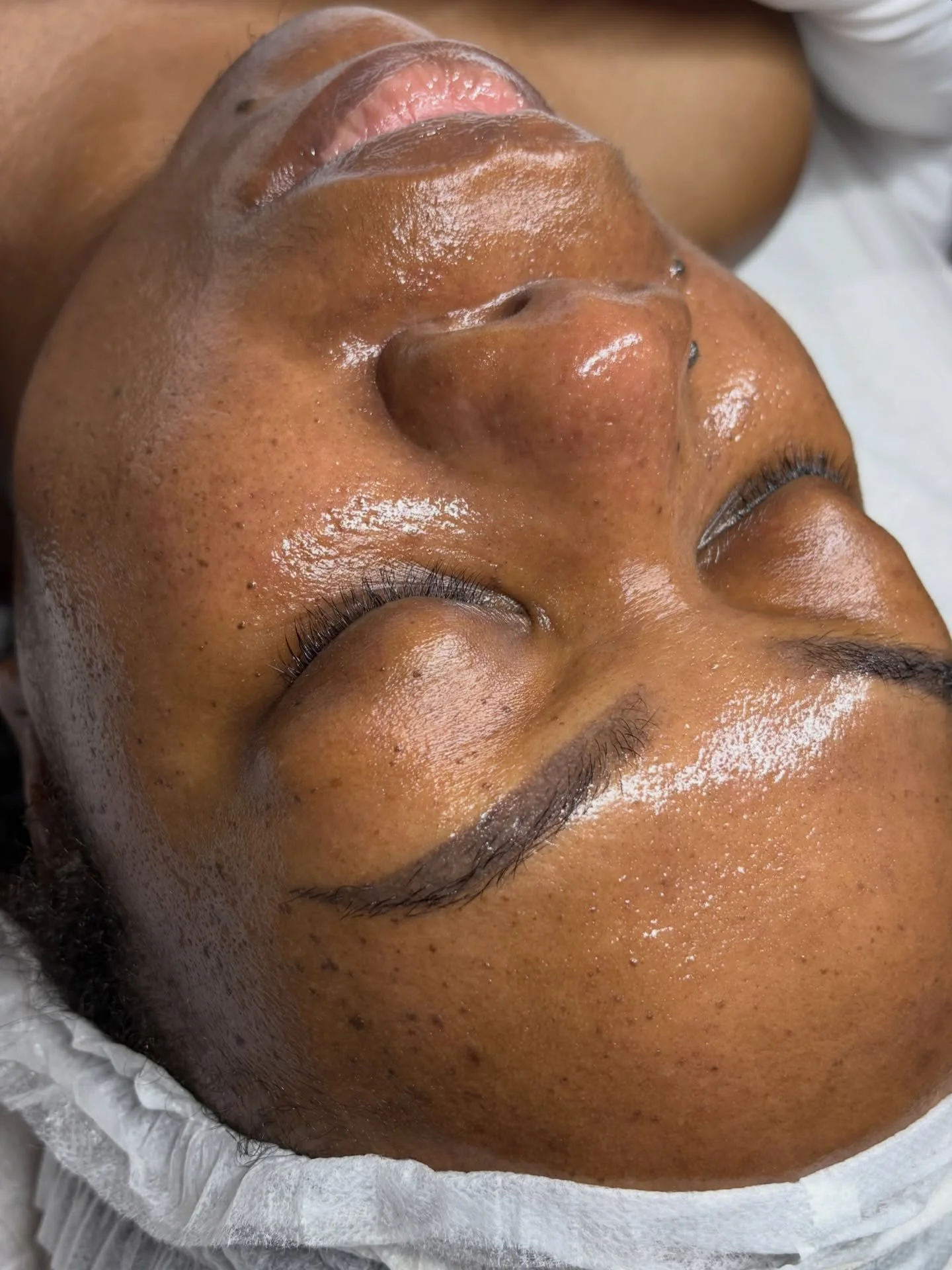 6-Weeks Post Advanced Peel | Recovery 

My client trusted the process and now look at the results! 🤎

Advanced peels CAN be done on melanated skin, you have to go to the right professional!

www.tahirahelahiesthetics.com

📍Arlington, TX (Entertainm
