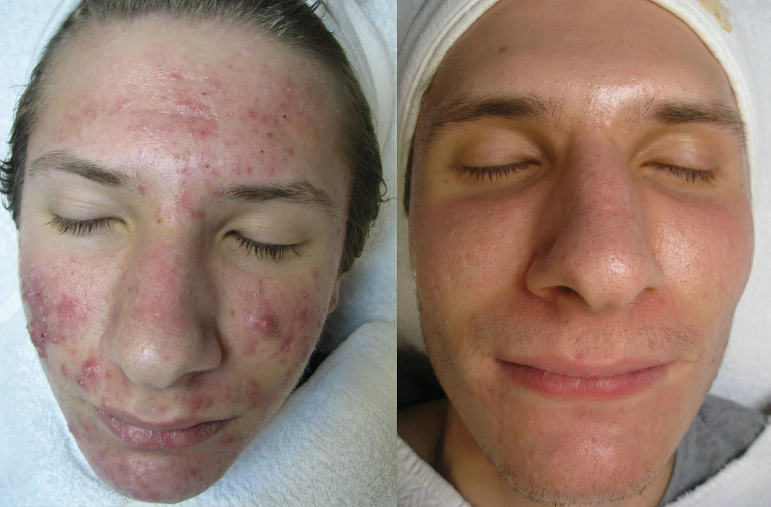 Comparison of a person's face before and after skin treatment. The left side shows the face with severe acne and redness, while the right side shows clear, smooth skin with a relaxed expression.