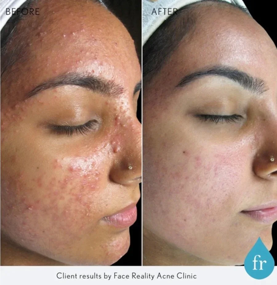 Before and after photos of a woman showing significant improvement in acne and skin clarity after treatment with Face Reality.