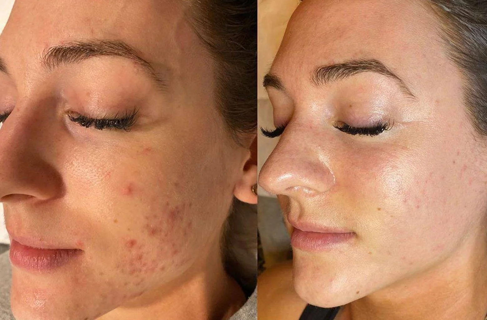 Face Reality side-by-side comparison of a woman's face before and after skincare treatment, showing clear skin on the right and acne scars on the left.