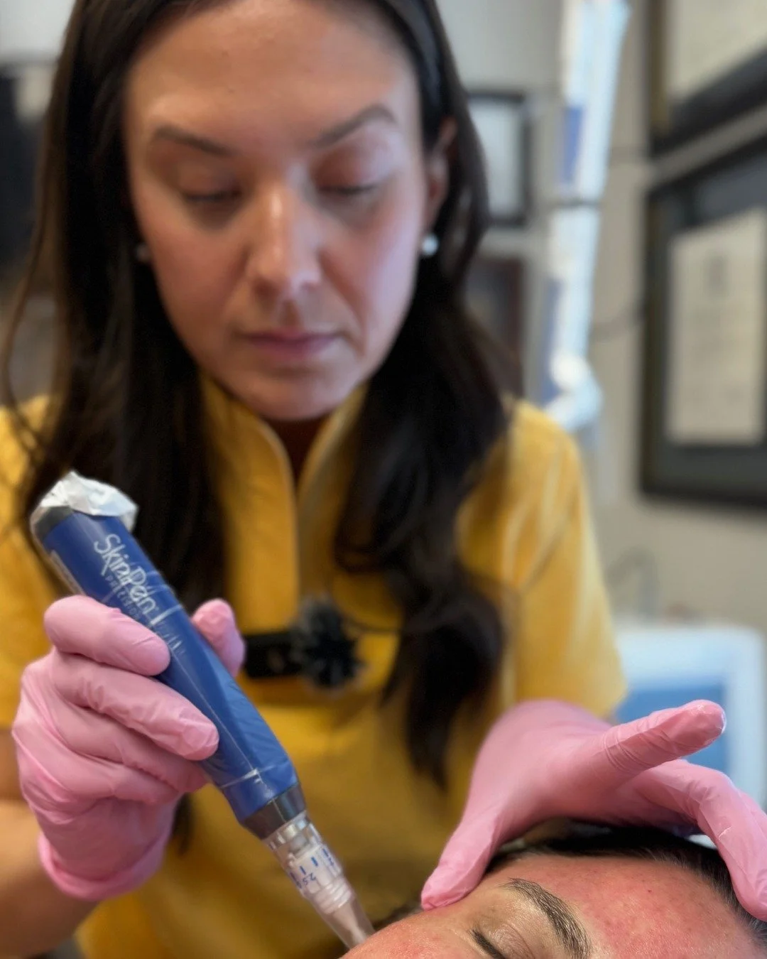 SkinPen uses controlled microneedling to kickstart collagen production, improve texture, and help with fine lines or acne scars 💉
It&rsquo;s a quick in-office treatment with natural, gradual results.
#SkinPen #Microneedling #DSCC #MeridianMS