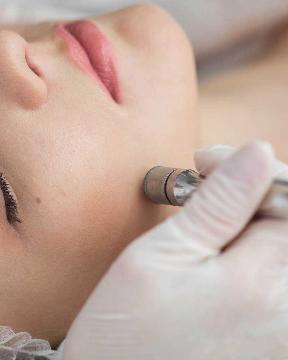 Laser Fractional CO2