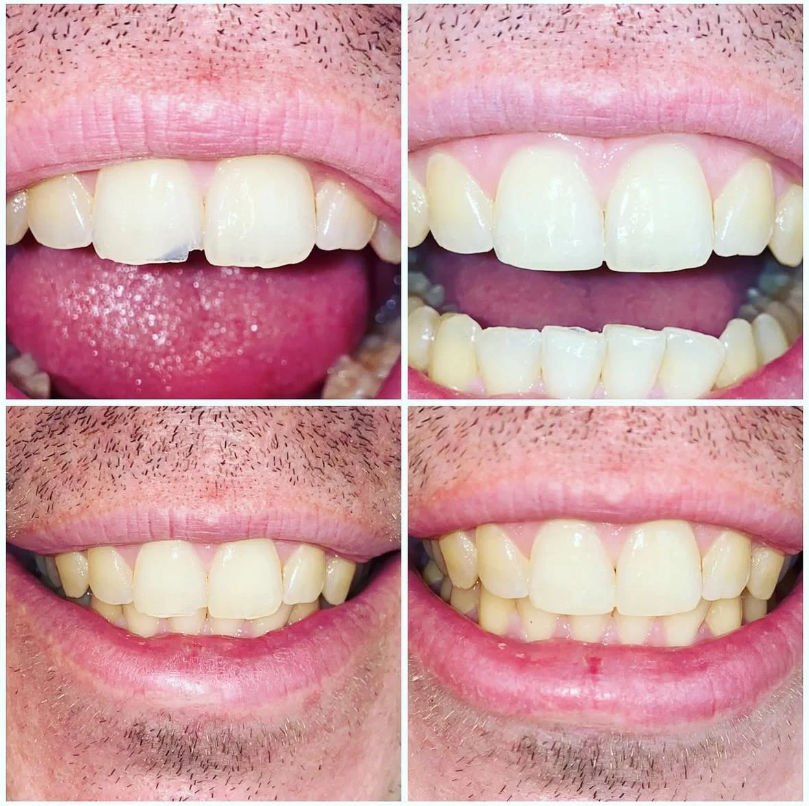 MFD_Chipped Tooth Fixed with Filling 3.jpg