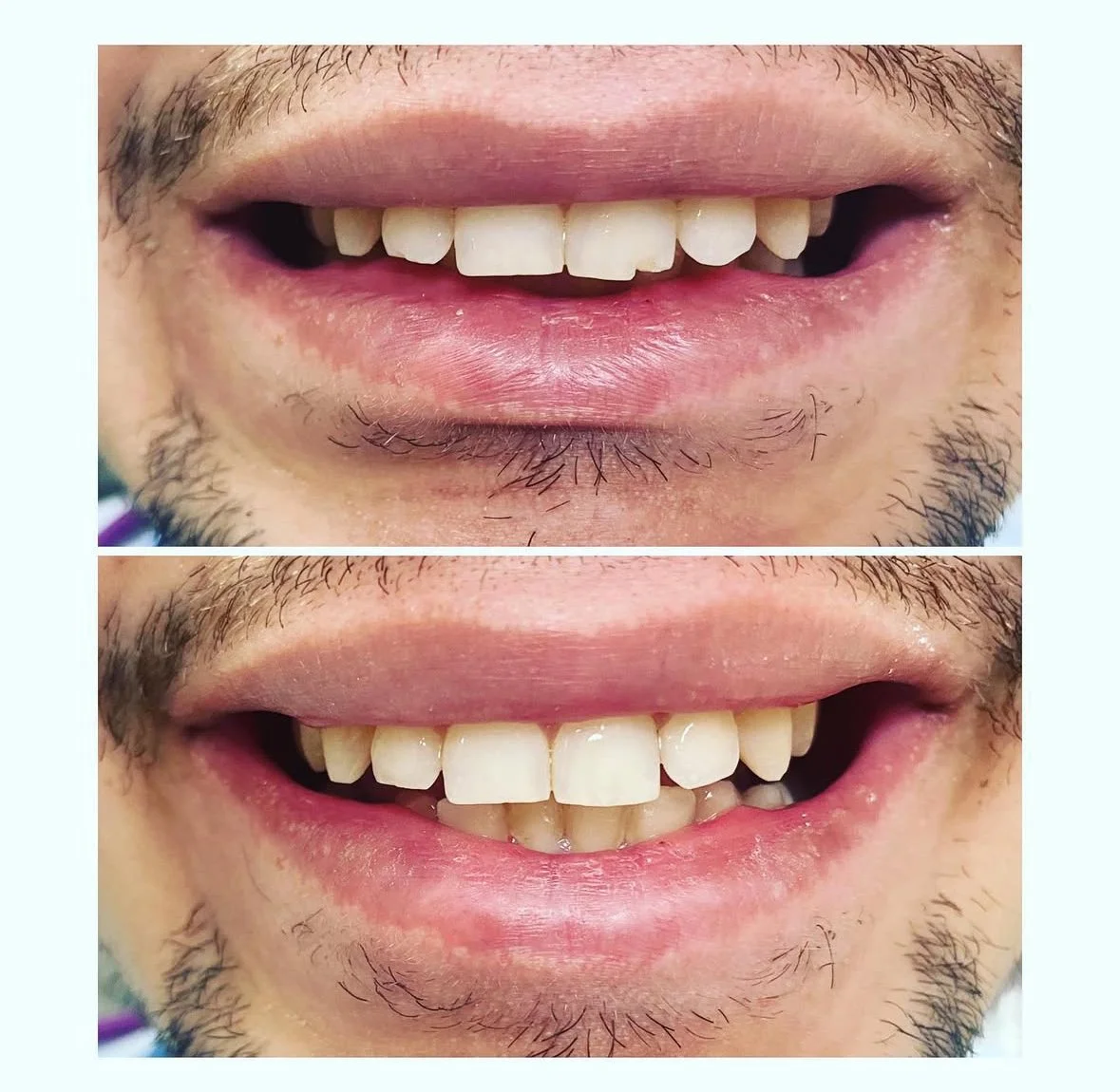 MFD_Chipped Tooth Fixed with Filling 8.jpg