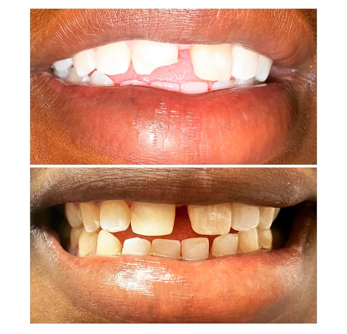MFD_Chipped Tooth Fixed with Filling.jpg
