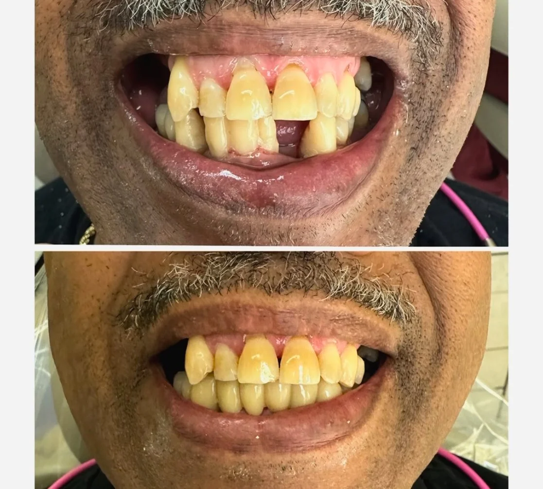 MFD_Dental Bridge on Lower Teeth 1.jpg