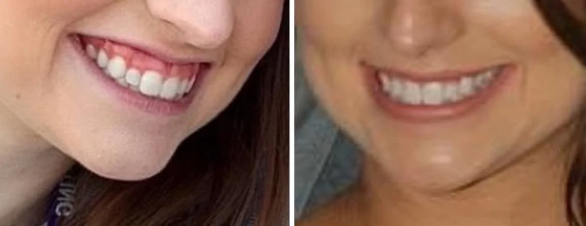 MFD_Botox to Fix a Gummy Smile.jpg