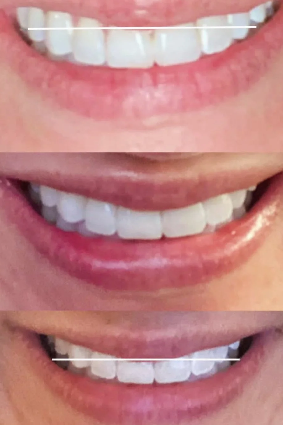 MFD_Lowering Uneven Smile with Botox.jpg