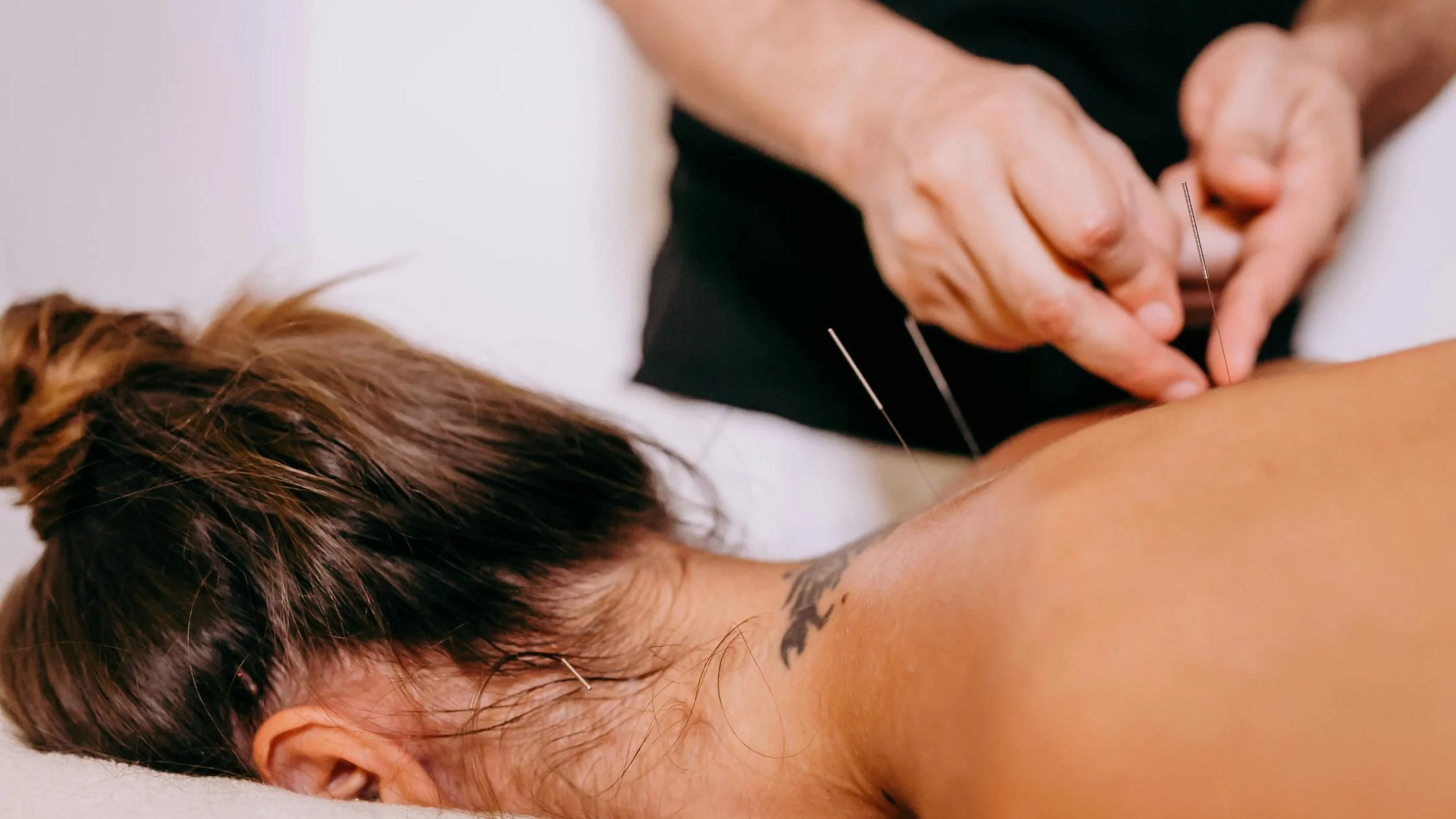 Does Acupuncture Help Hormone Balance?