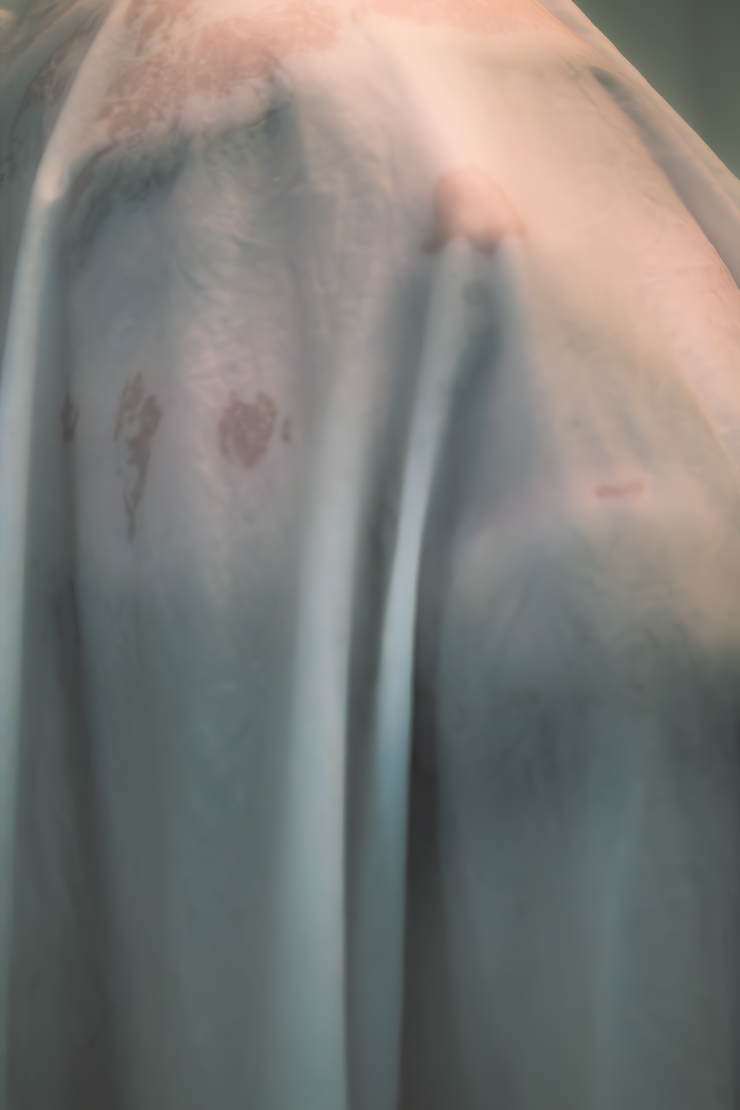 Close-up of a person lying on an examination table with their draped body partially visible, covered with a sheet.