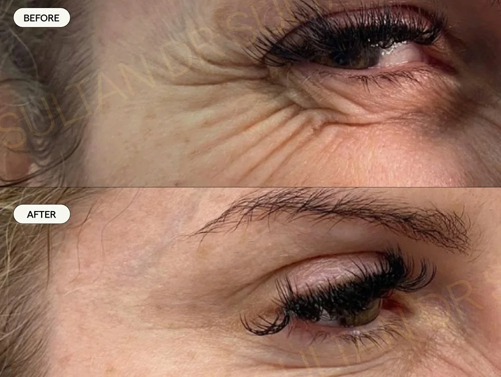 Botox treatment to crows feet while still giving a natural appearance