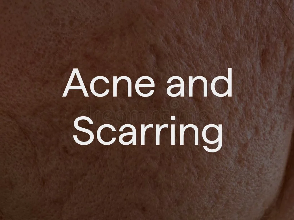 Close-up of human skin showing acne and scarring.